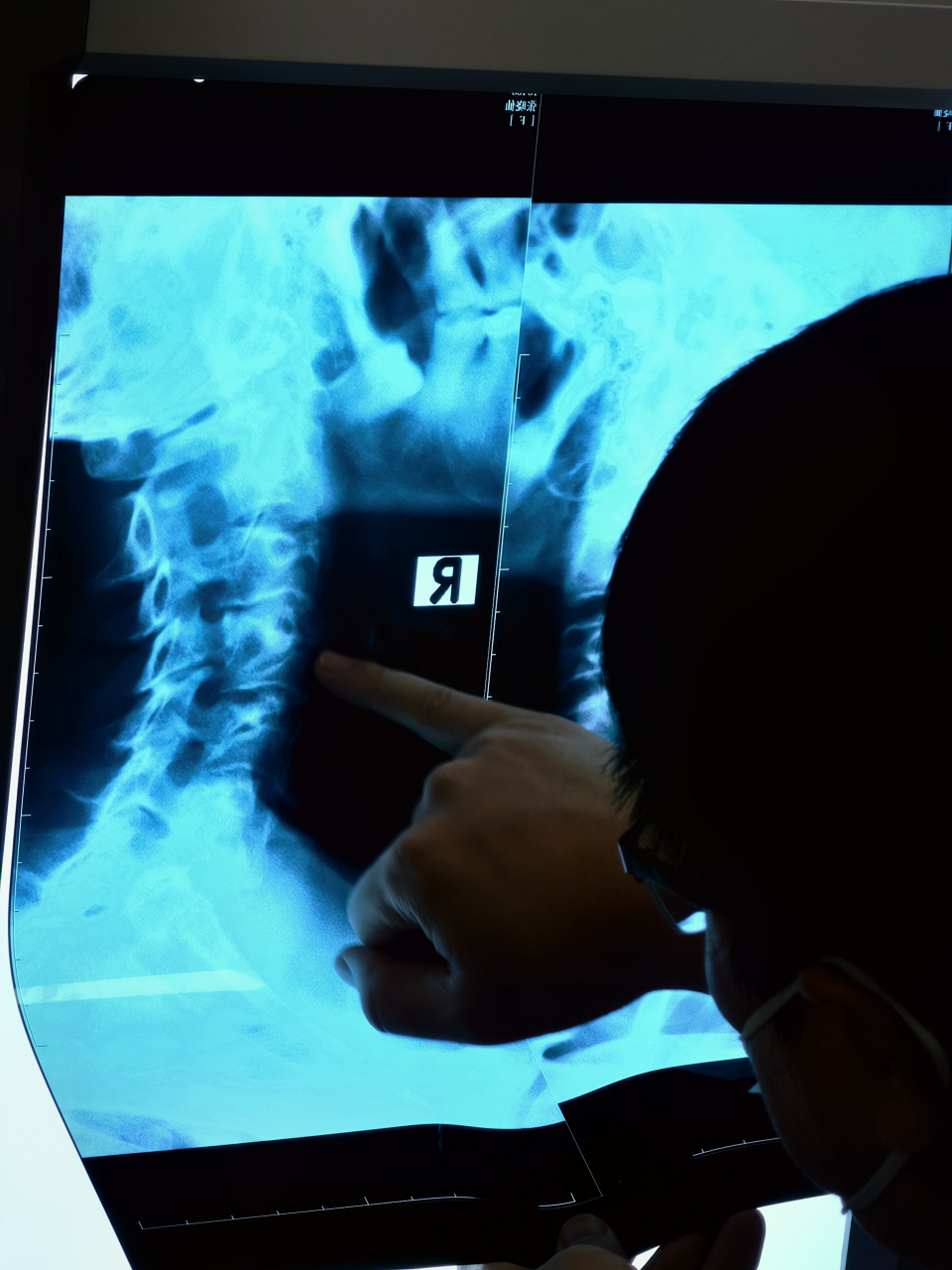 48岁神经根型颈椎病当地建议手术,她是怎么做到保守治疗三年没有复发