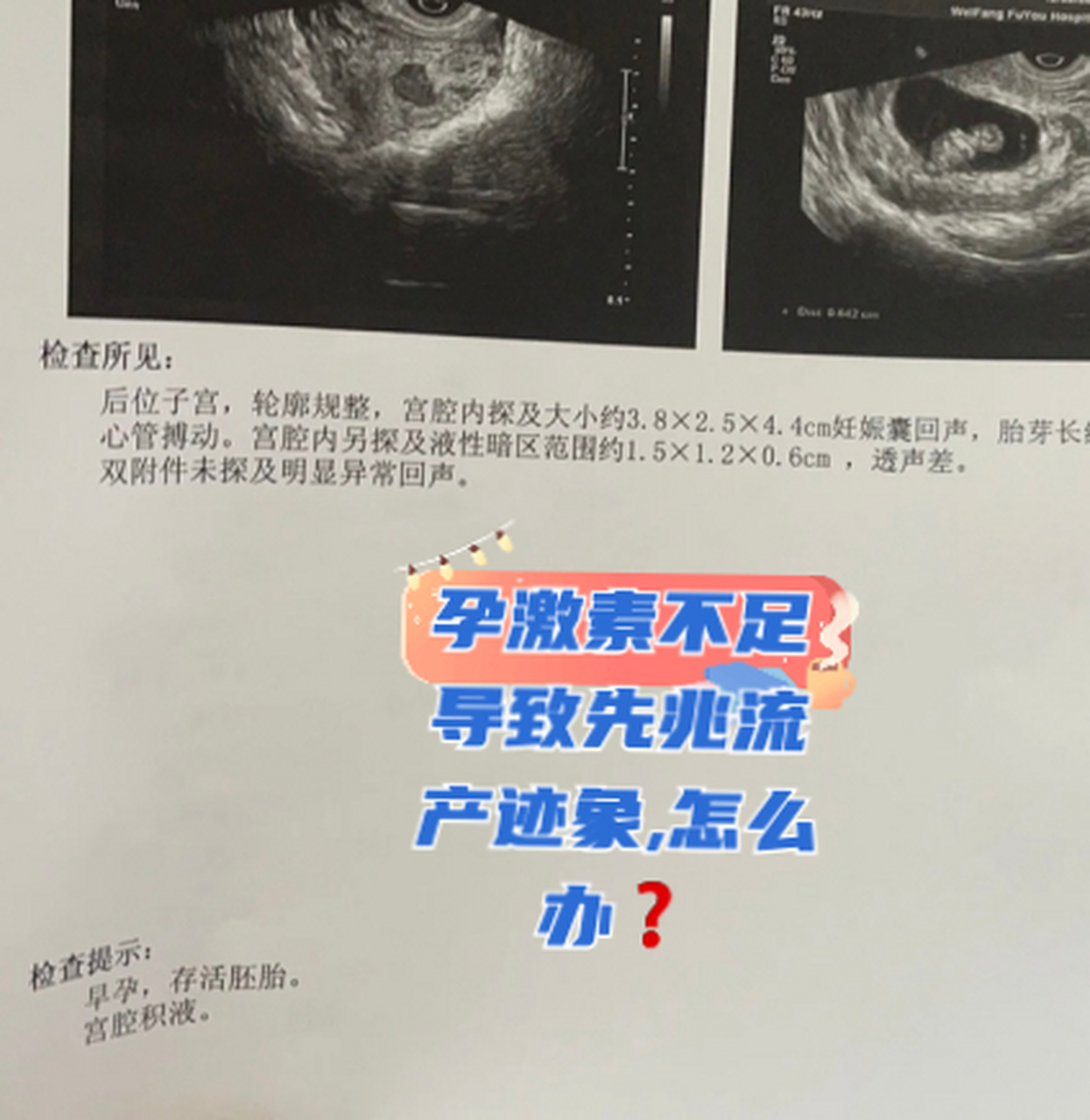 0299孕激素不足导致先兆流产迹象,怎么办71  结婚半年怀孕了
