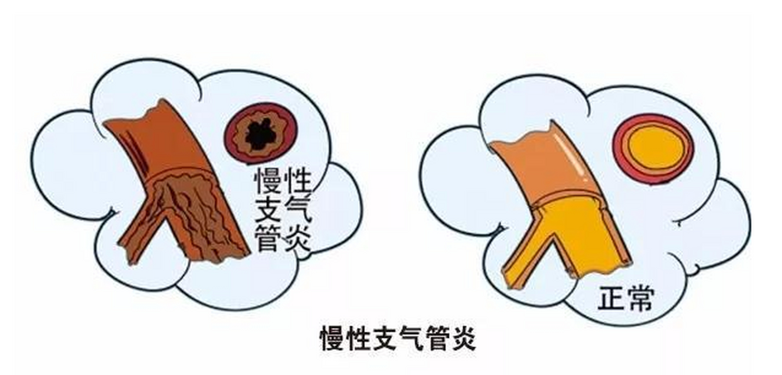 这3种特点的咳嗽小心慢性支气管炎 慢性支气管炎是一种慢性炎症性疾病