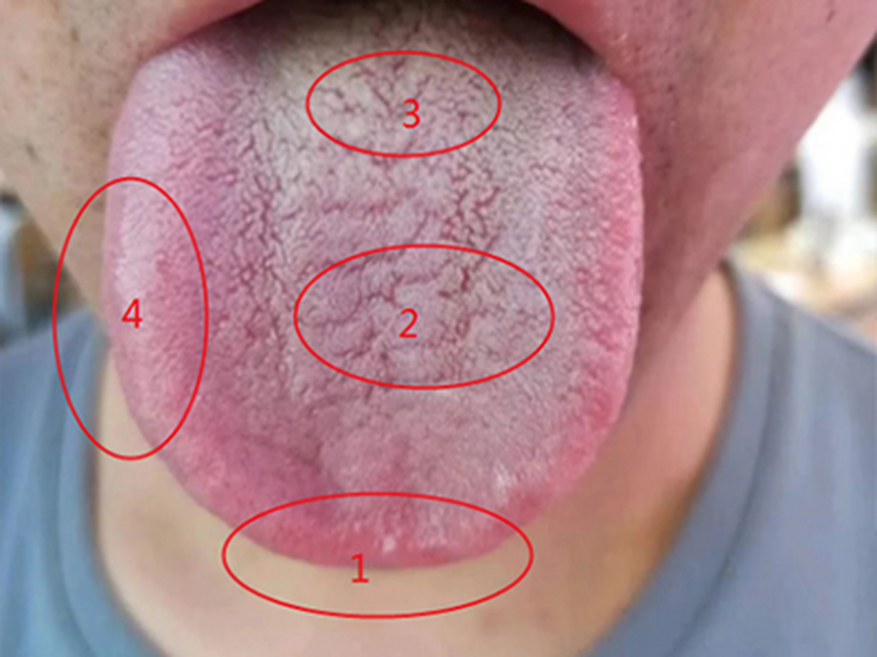 【每日舌诊:上焦有热,下焦湿浊,脾胃虚】  这是一位20岁男同志的舌象.