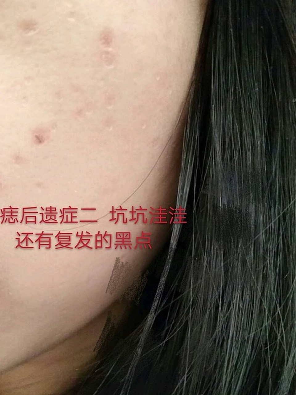 激光点痣一般是不会留下疤痕的.