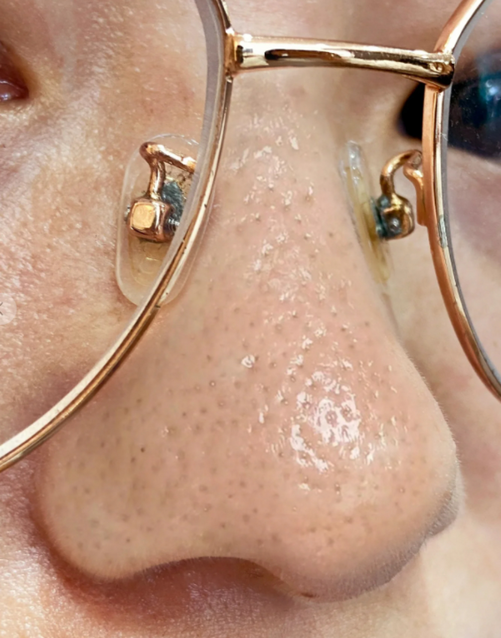 挤黑头留下的坑是很多人的困扰,我也曾经因此苦恼.