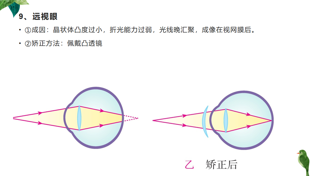 远视眼是一种常见的视力问题,其成因是晶状体凸度过小,折光能力过弱