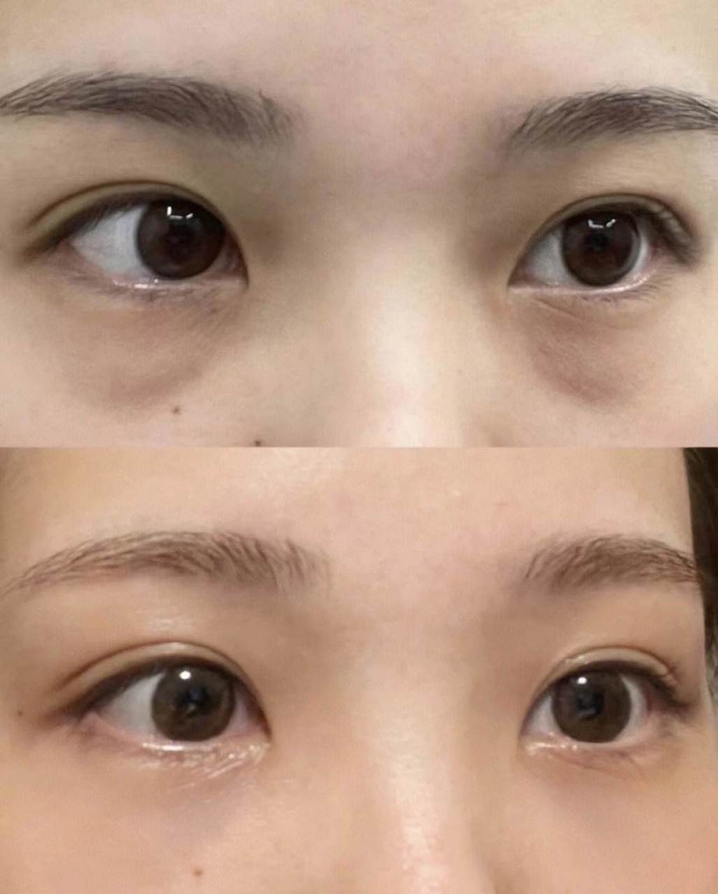 理性处理眼袋 眼袋比较轻微的一些求美者,她就会来问我说医生,我的