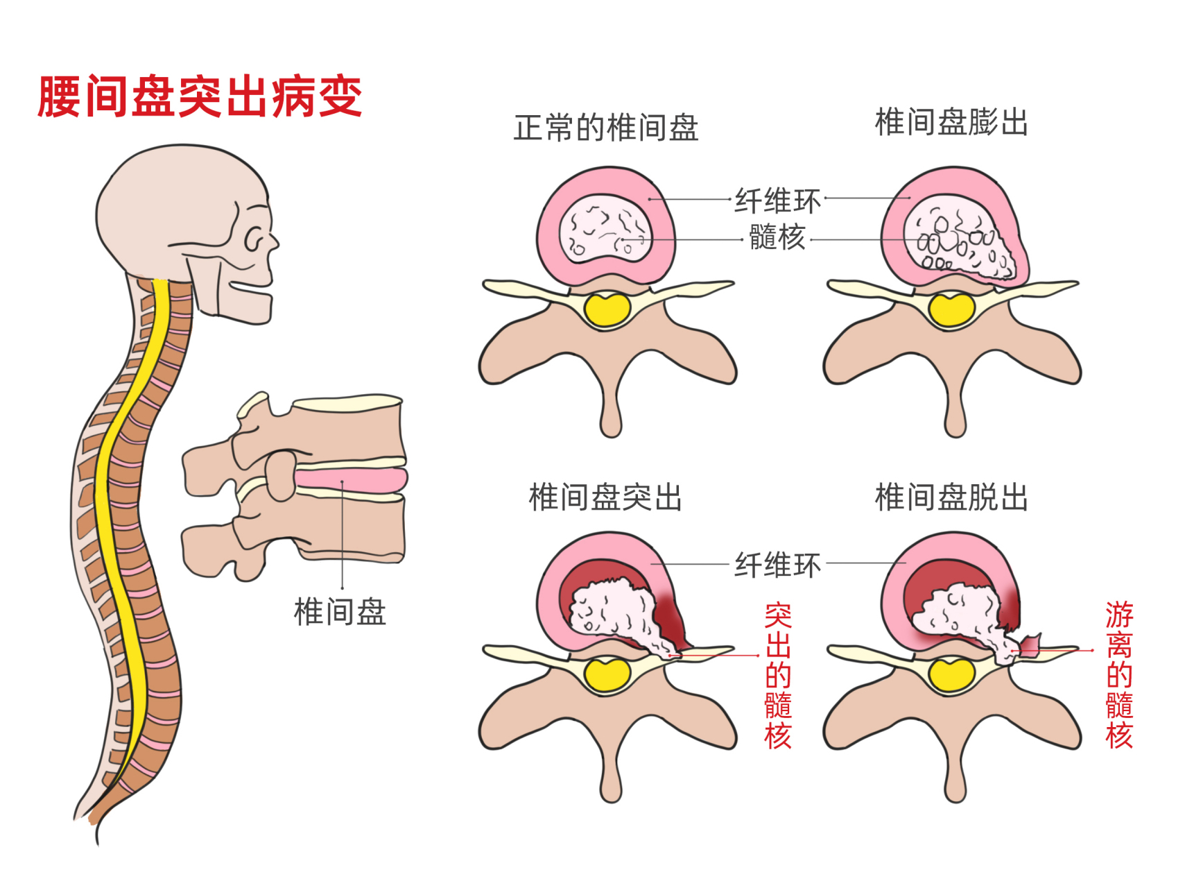 腰间盘突出卡通图图片