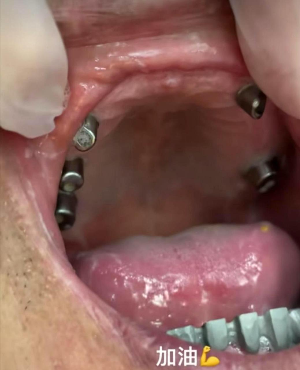 这是装铁牙吗?如果不小心咬到舌头,那可真是疼死了!