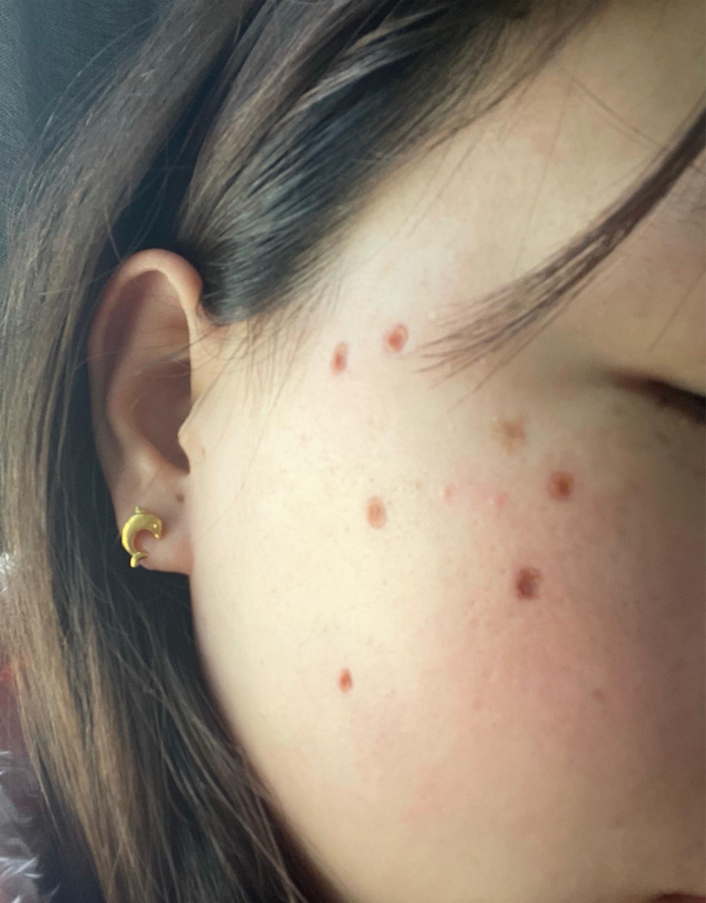 脸上的痣图片及全解  关于脸上的痣,一般人除想到是否美观外,还有就是