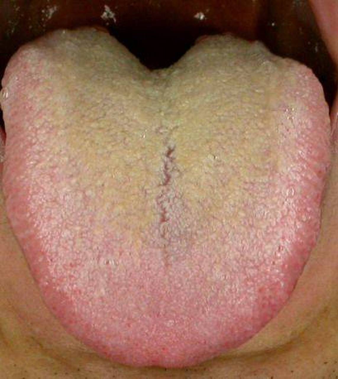 舌头有裂纹?一个古方降虚火消裂纹你的舌头有裂纹吗?