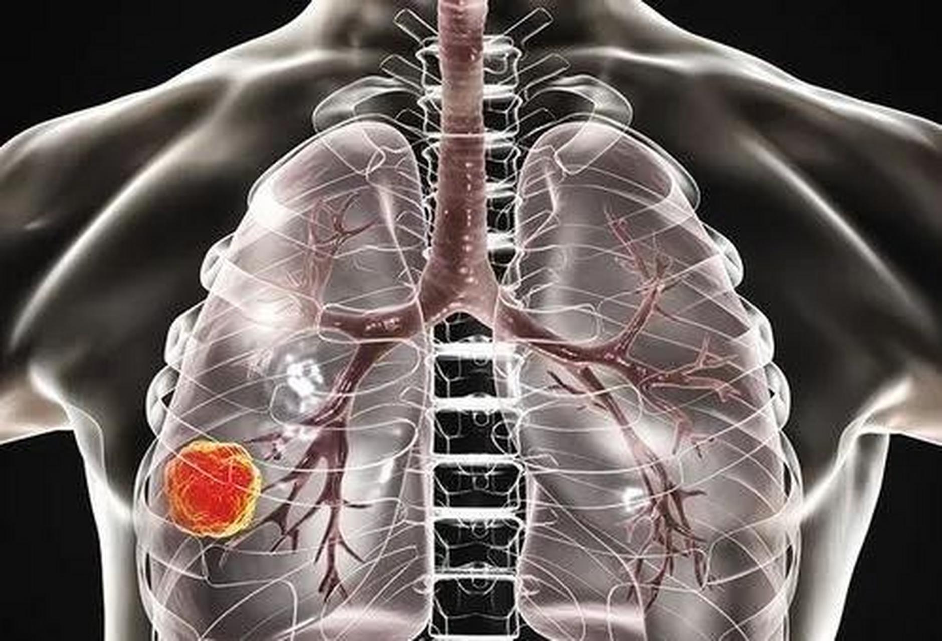 对于患有肺癌的病人来说,最重要的是早期发现和早期治疗.