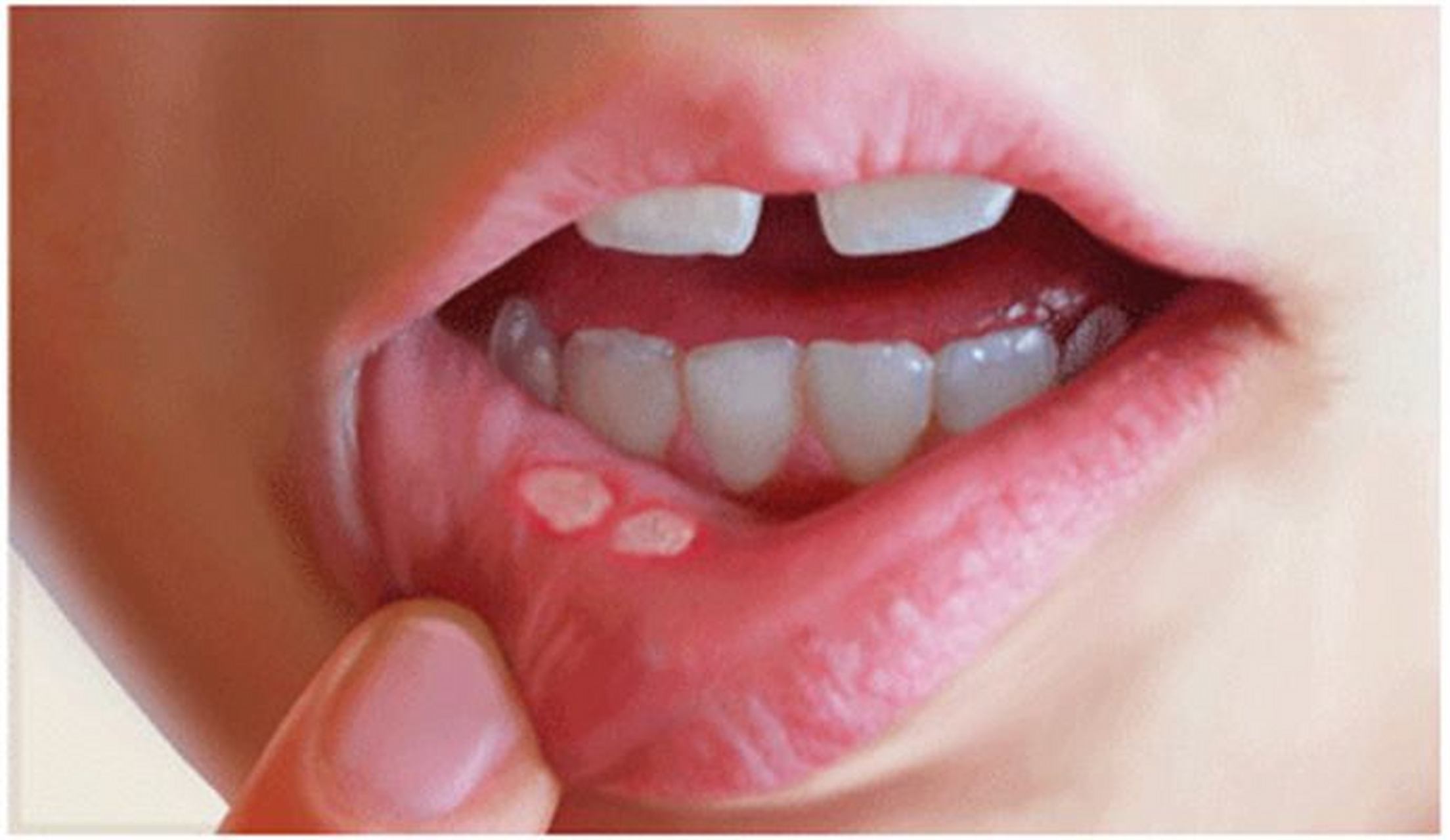 很多朋友们在体检的时候总是会忽略口腔疾病检查,认为口腔里面除了
