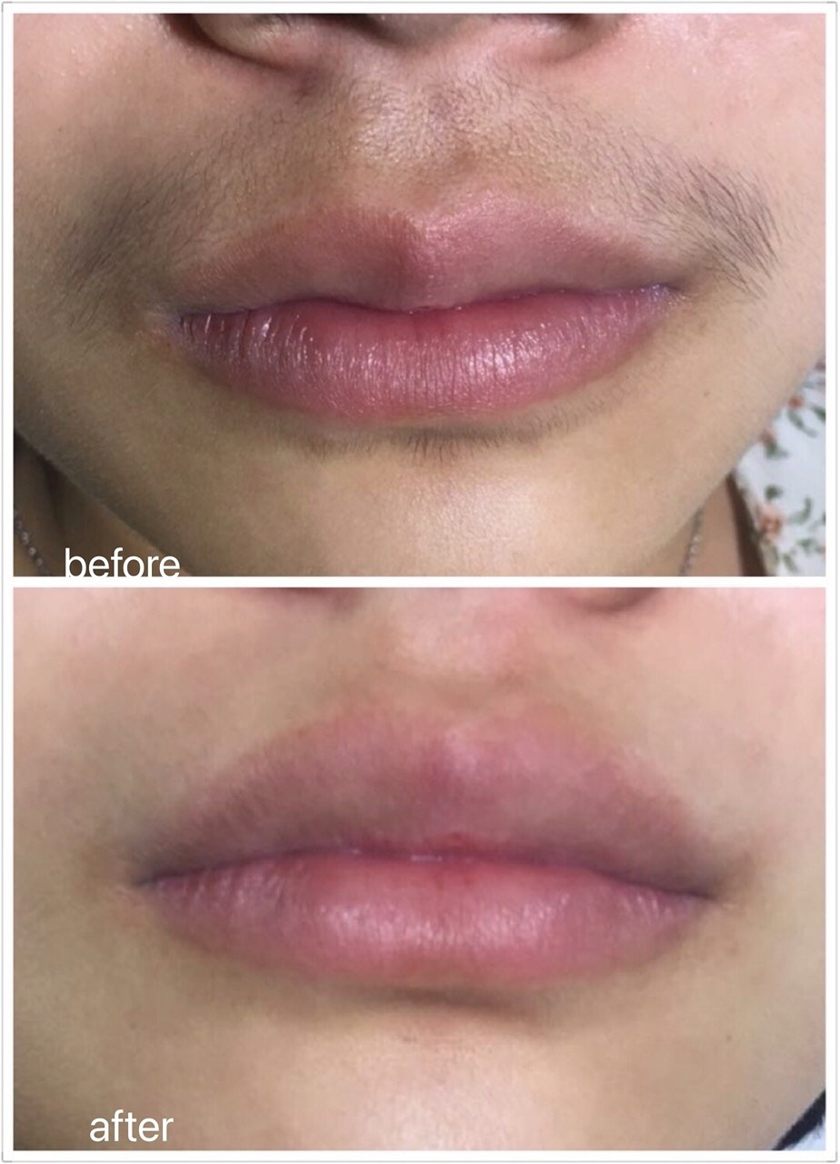 唇毛的解决办法有了!脸部冰点脱毛能搞定!