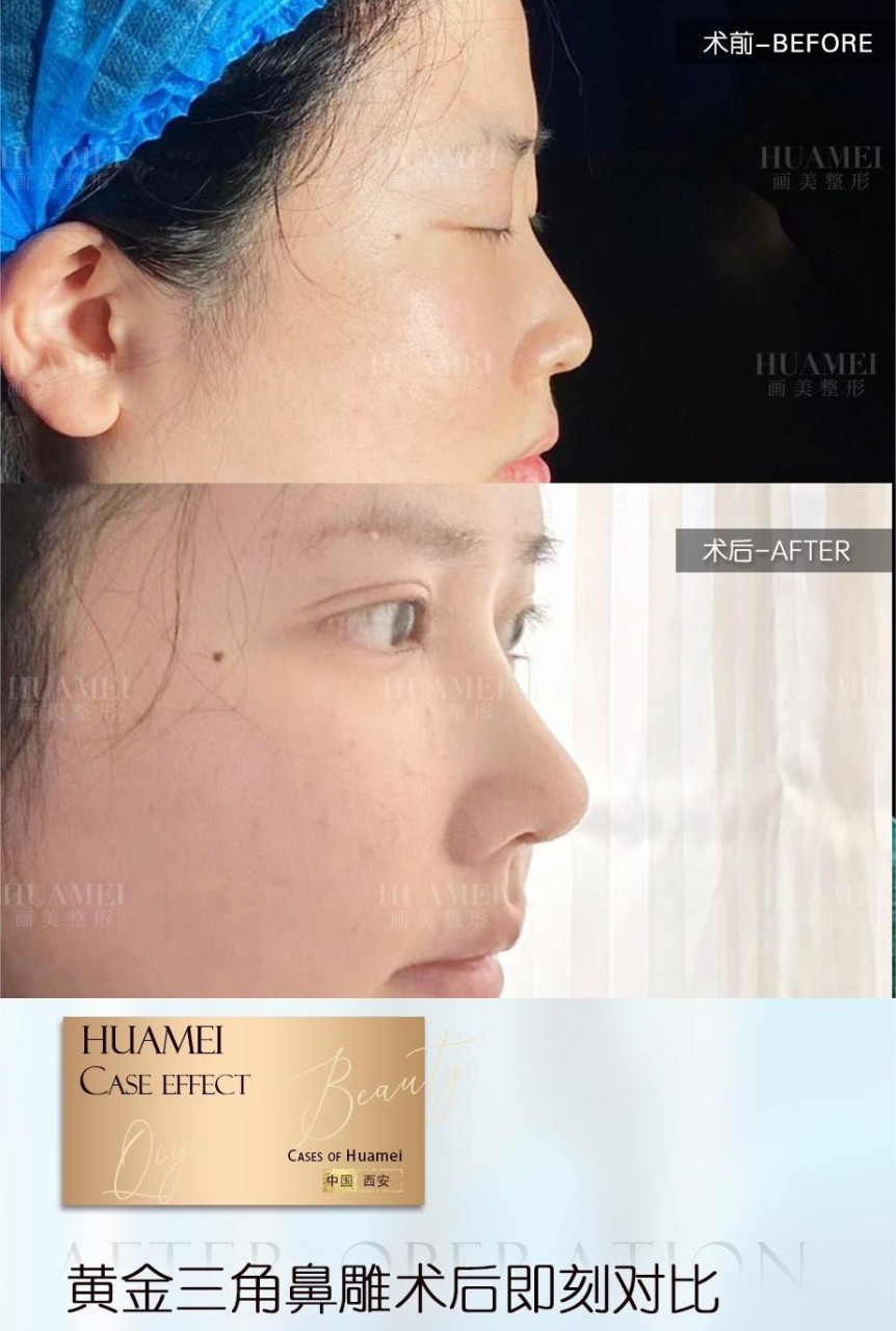 黄金三角鼻雕术案例效果对比  71术前鼻头弯曲 鼻翼缘肥大 [微风]术