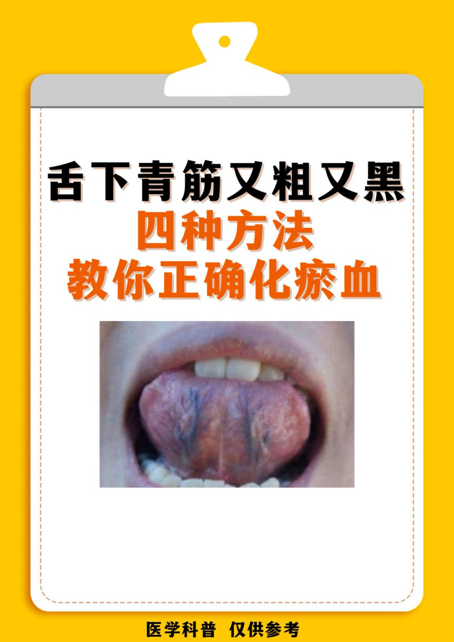 舌头下面青筋又黑又粗,教你四招轻松化淤血#舌苔# #淤血# #疏通淤血