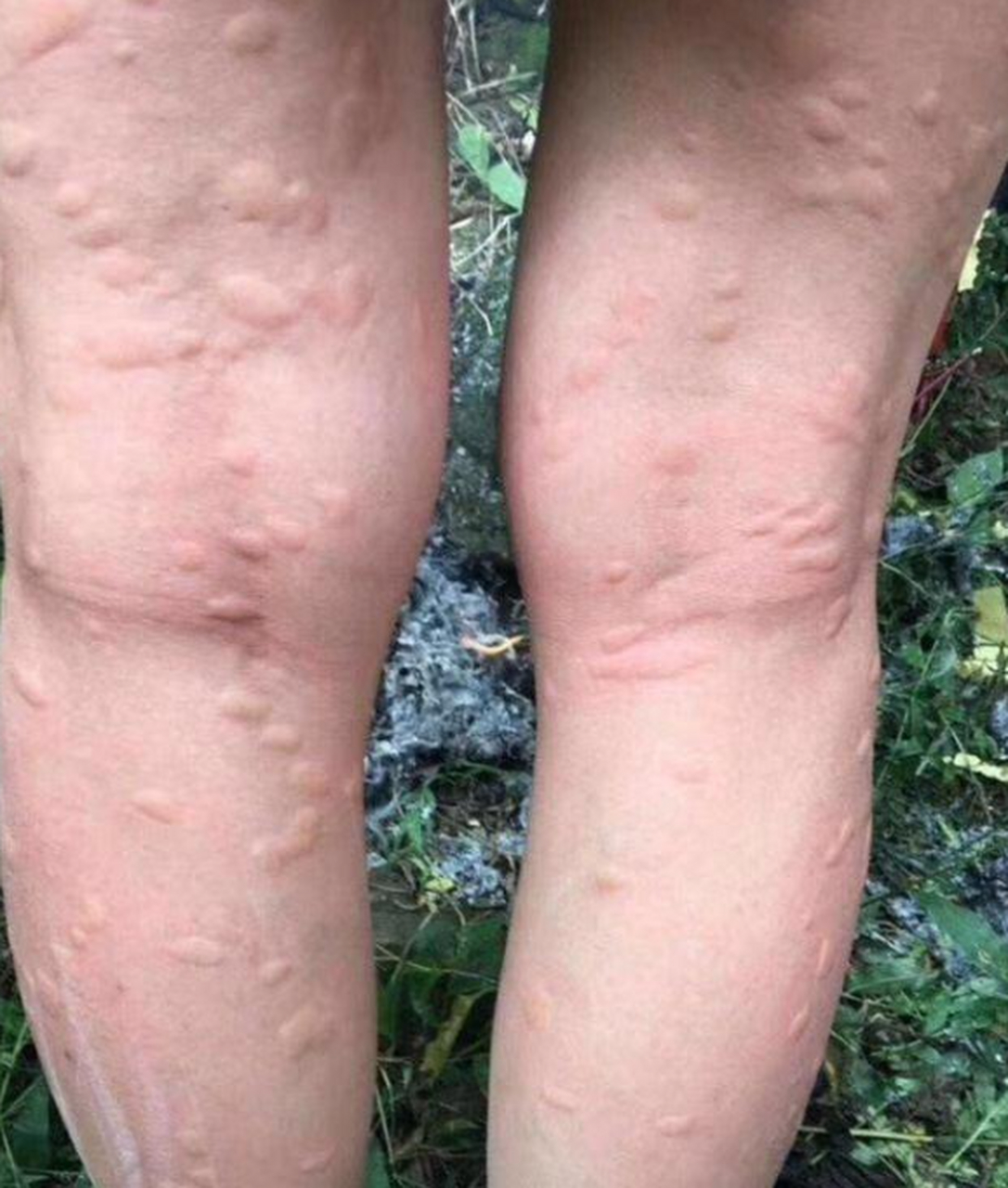 网友:我去竹林采风,被很多蚊子咬了