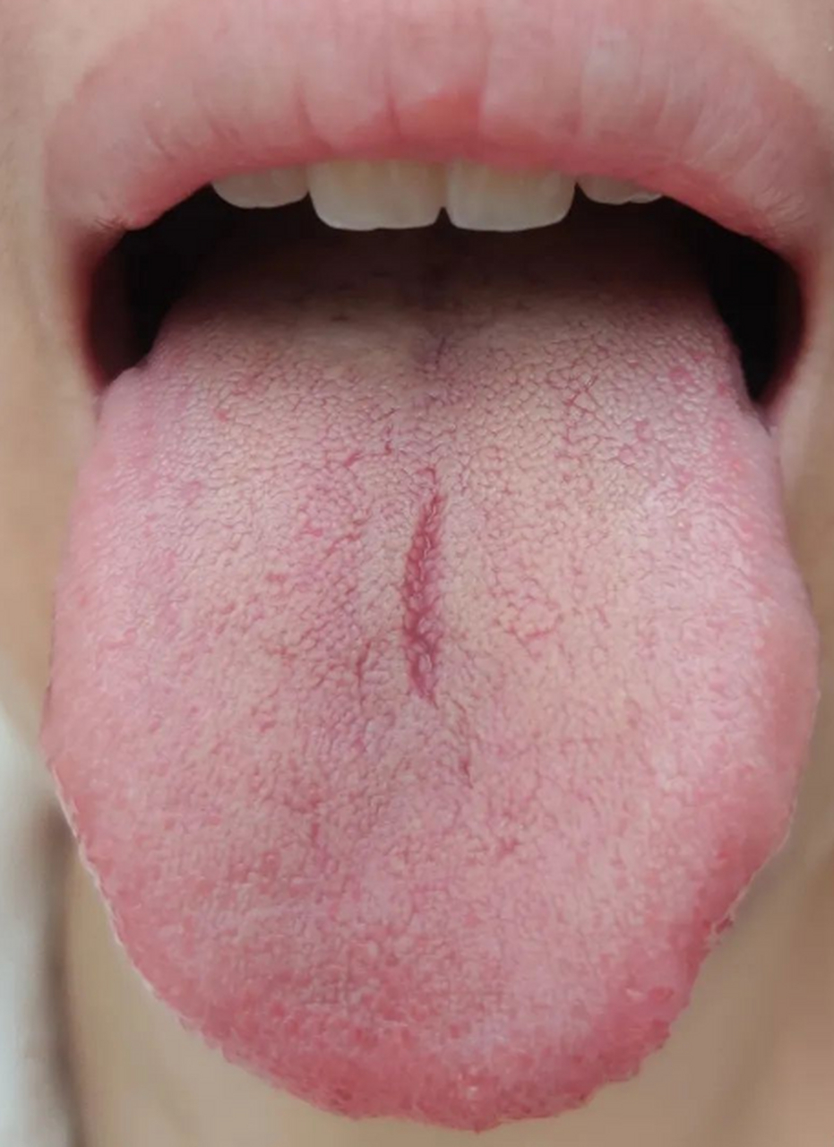 这个人,舌尖红,一般女同志见到舌尖红,首先要问是不是在月经期,月经期