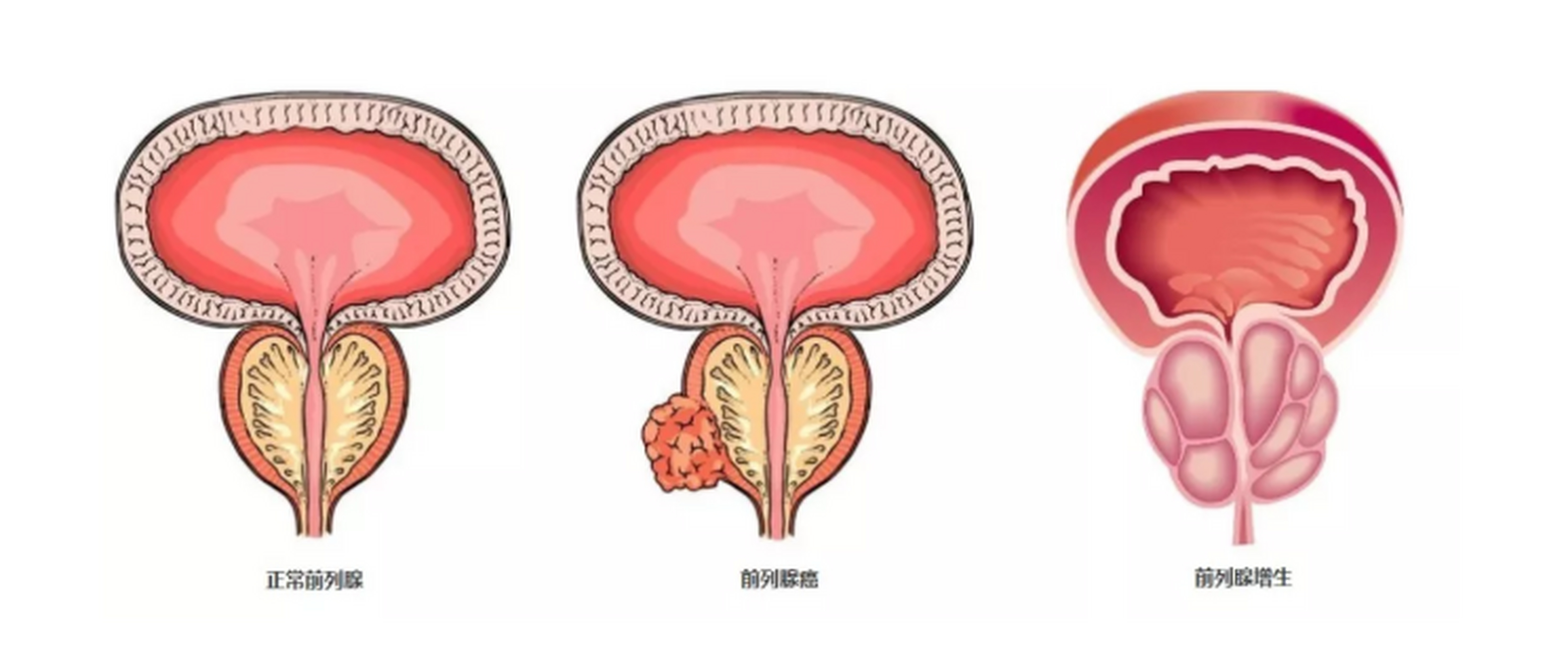 关于前列腺增生和前列腺癌的那些事,你了解多少?