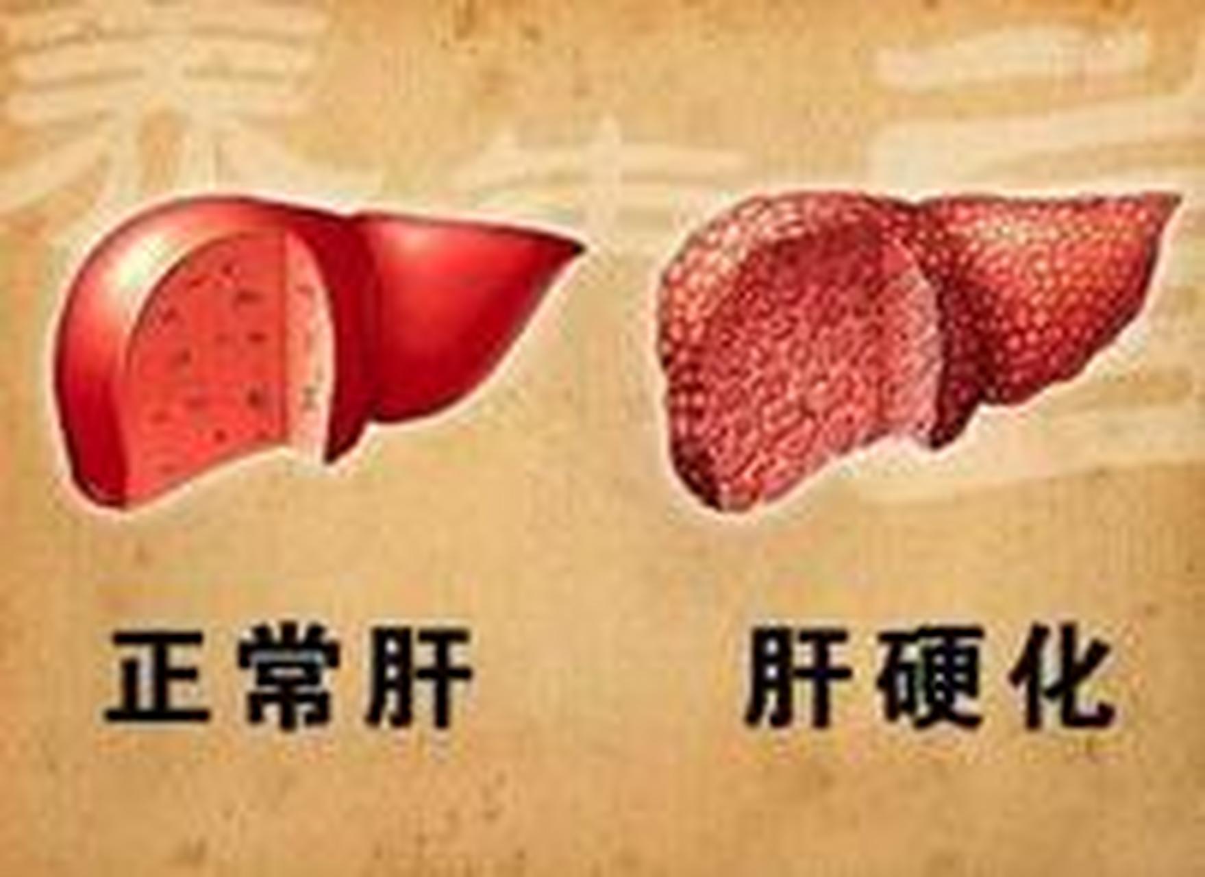 代偿期肝硬化症状表现 一般没有明显症状表现,部分患者可有腹部不适