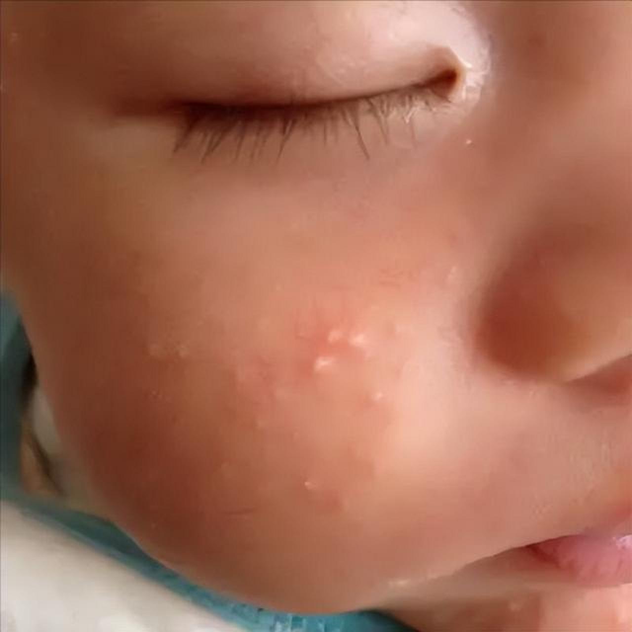 奶癣主要是指婴儿湿疹,因小月龄孩子只吃奶,所以常被称作奶癣!