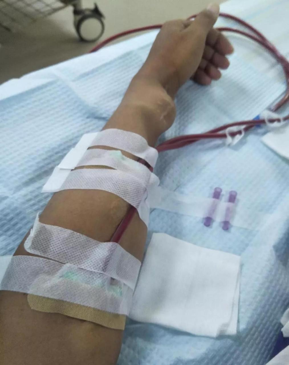 透析了11年的手臂,到处都是针眼,内瘘鼓包,不知道了是什么原因,难道是