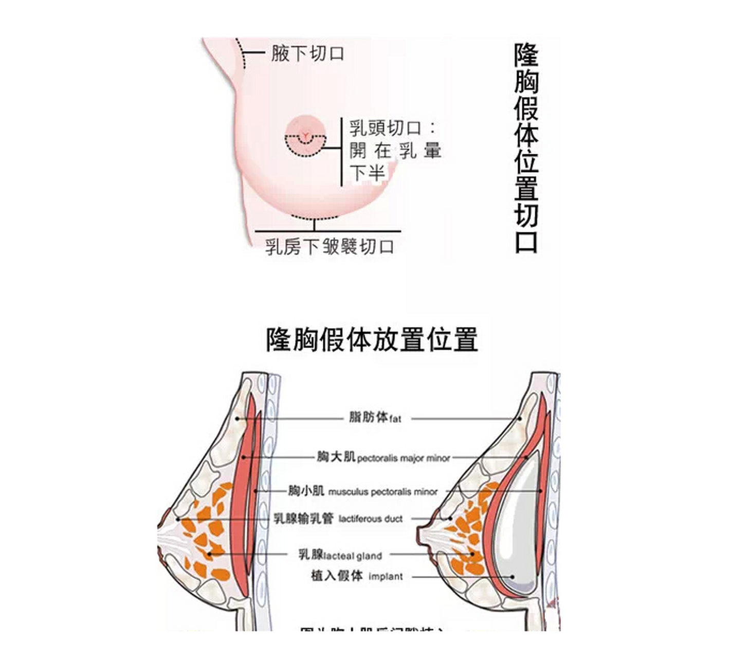 统一回复:首先疤痕是在下皱襞处站立正常情况下是看不到的,其次在患者