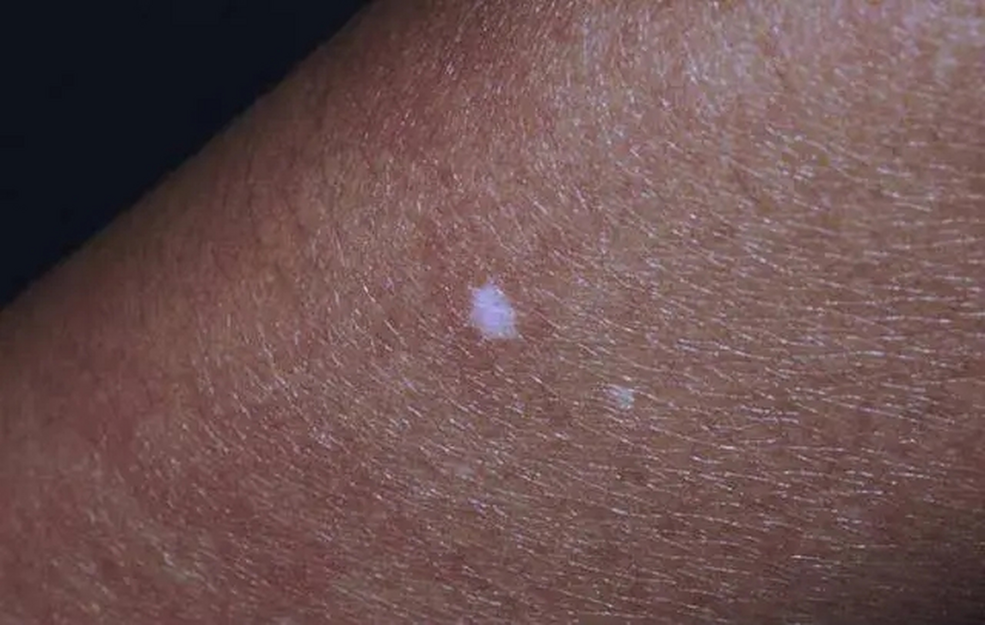 出现了一些小白点,有的人以为是白癜风    其实这叫特发性点状白斑