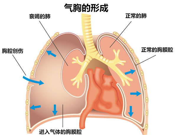 三种气胸的图片图片