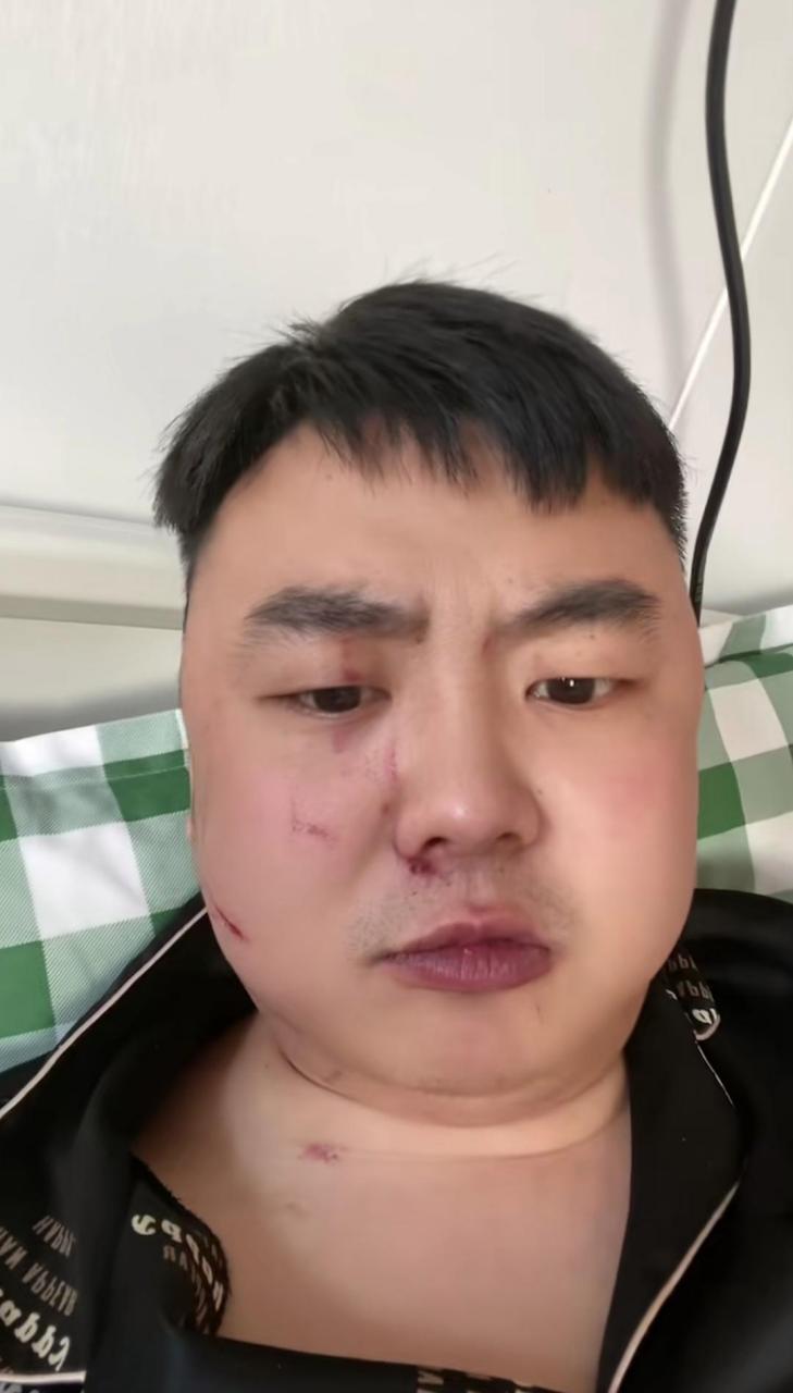 哥哥和嫂子吵架了,嫂子下手太黑了,把我哥哥脸挠成这个样子!