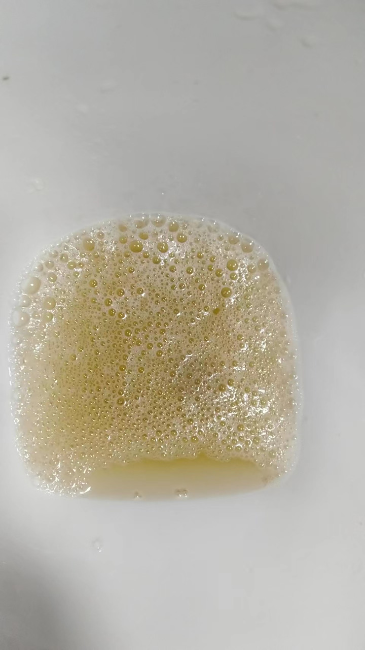 "   尿中出现泡沫,多是由于尿蛋白引起,一般提示有肾炎.