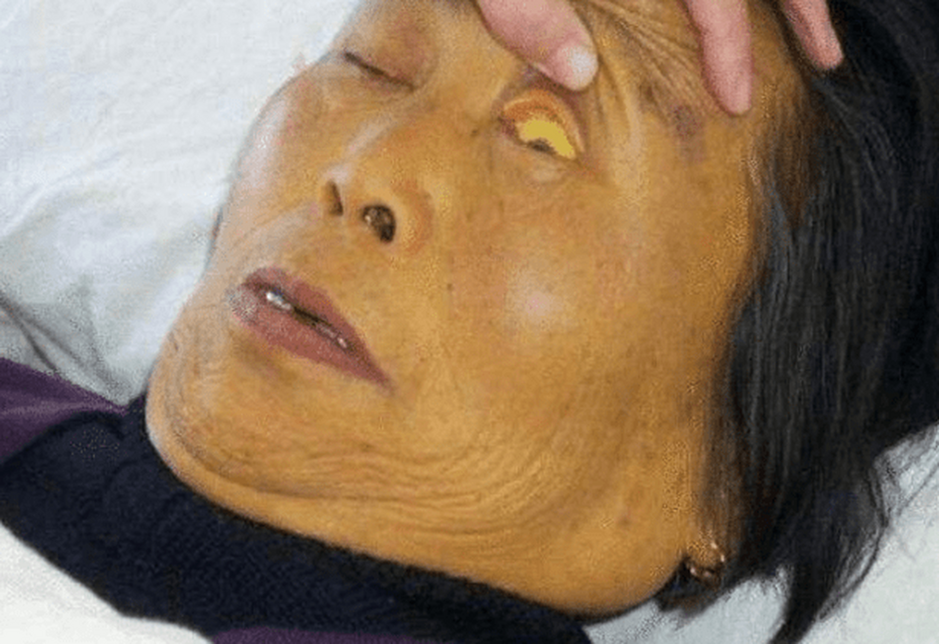 有这些特征的人,一般都是肝病面容 肝病面容是肝病患者特有的一种症状