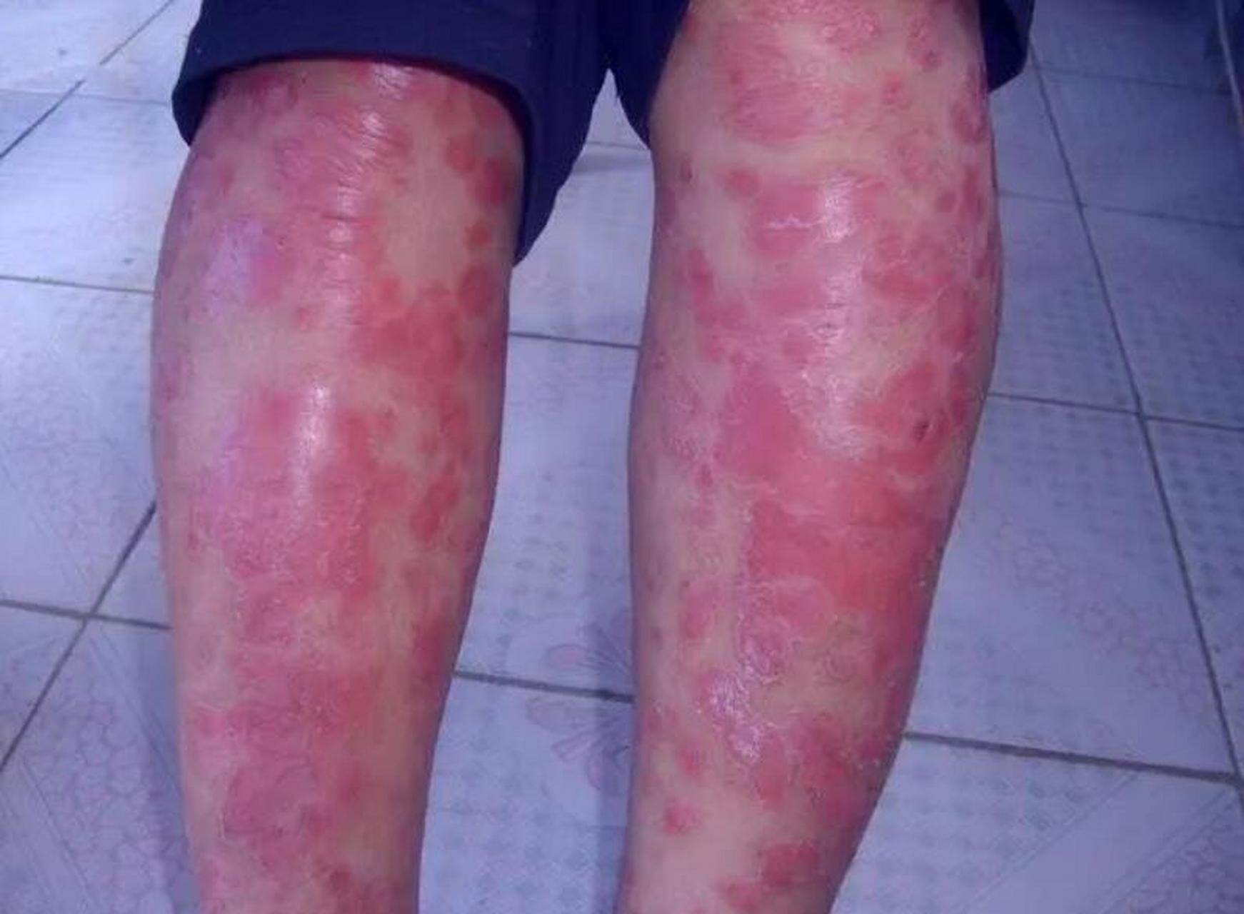 胳膊,腿上,四肢上的牛皮癣,两把草煮水很管用,镇定,抗炎,调免疫!