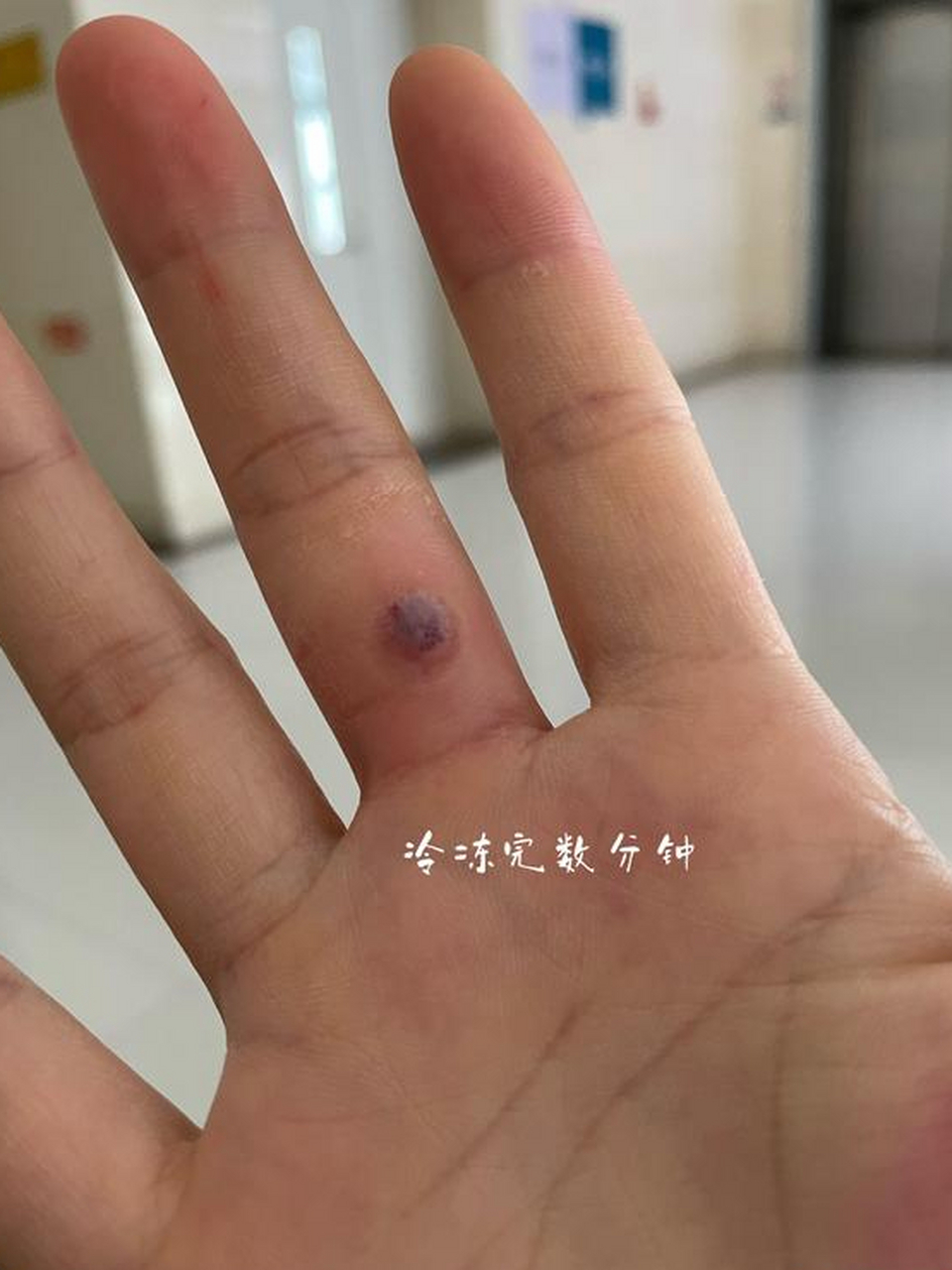 95 寻常疣治疗笔记  今年7月还是8月右手中指上破了个伤口,当时也没