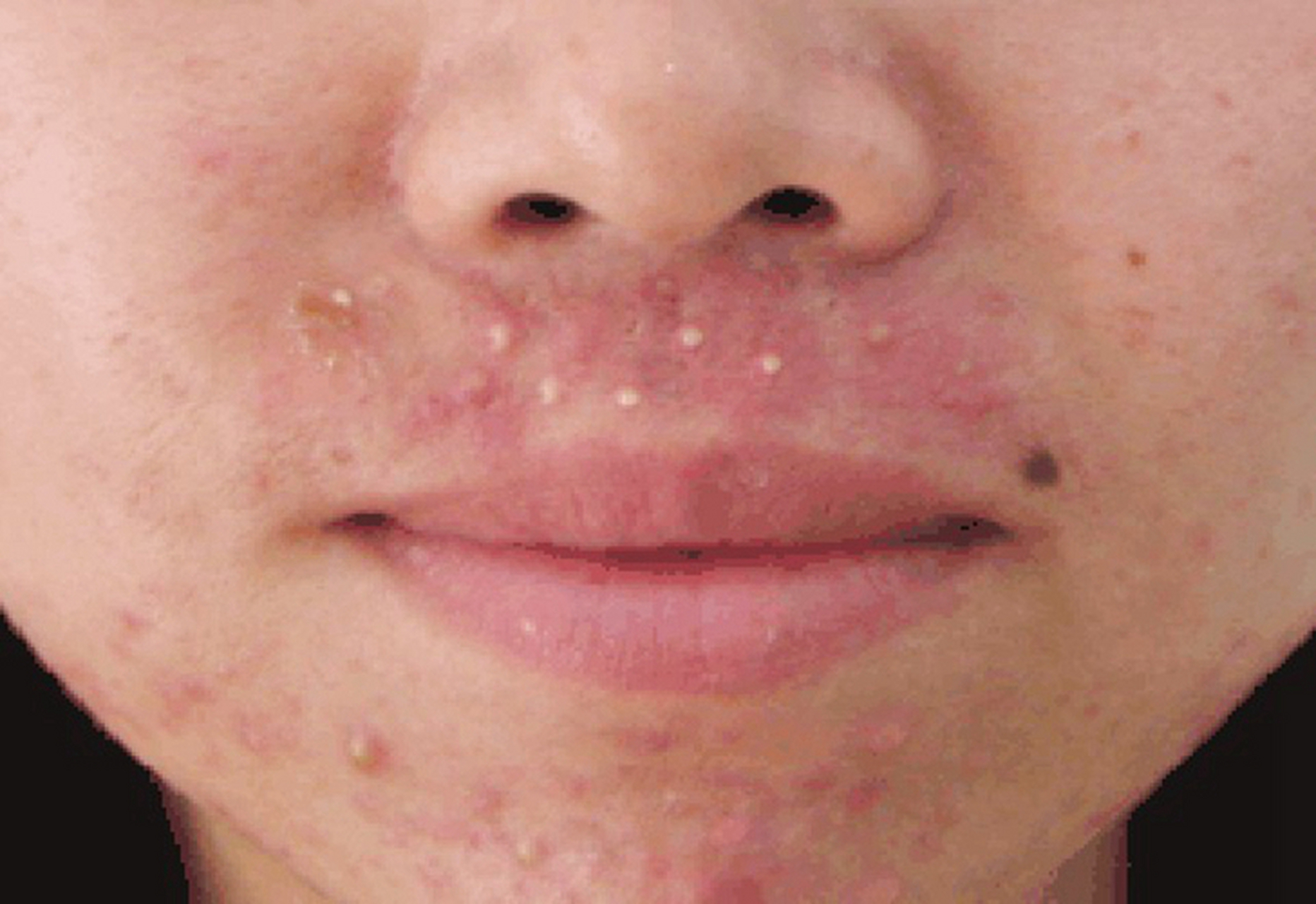 毛囊炎通常是由于细菌感染所致,毛囊炎化脓也是非常常见的一种现象,在