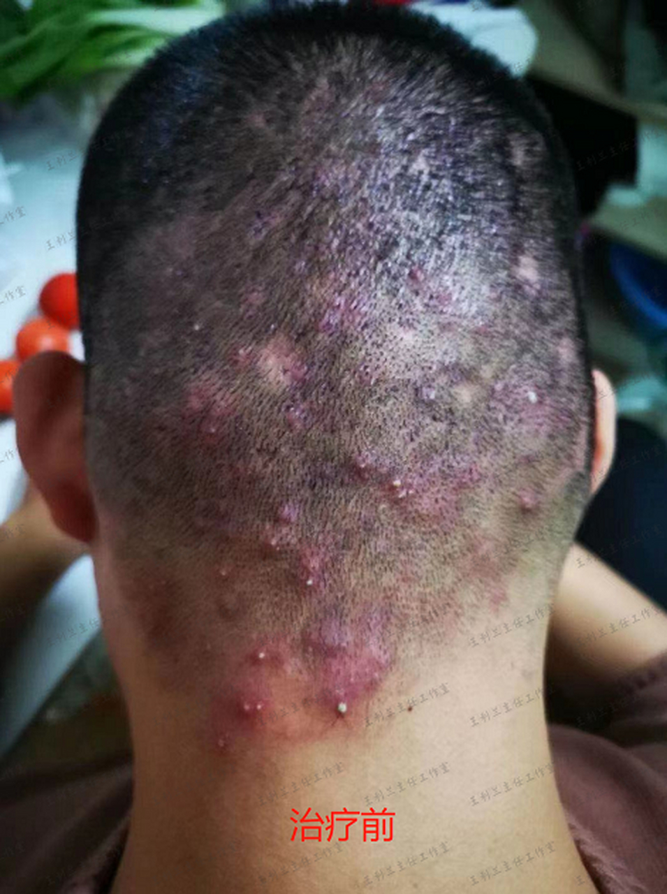 找准问题 对症施治 消退顽固毛囊炎 一个方子足够了  毛囊炎症在表病