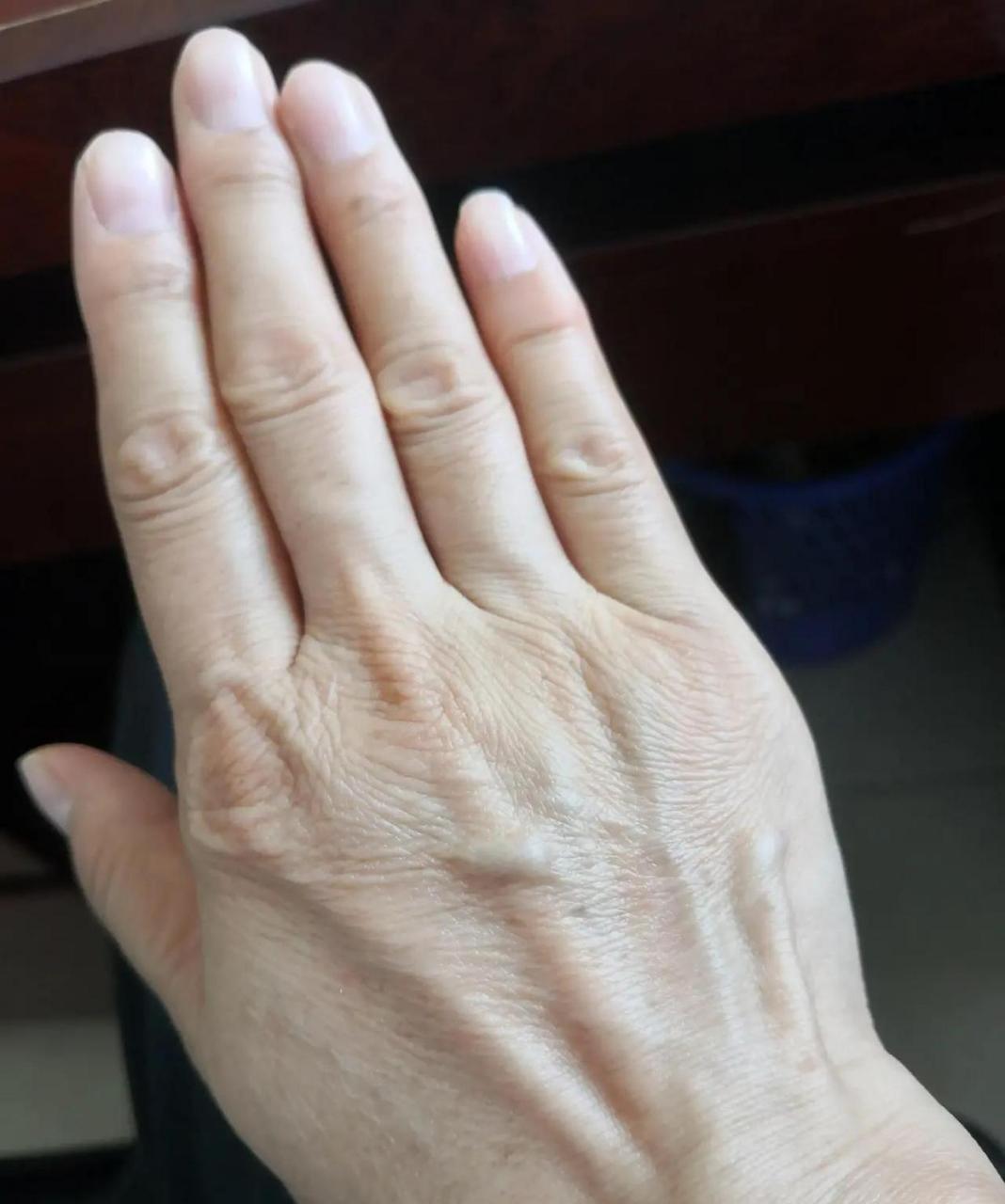 我还不到40岁,手背上就有了很多老年斑.