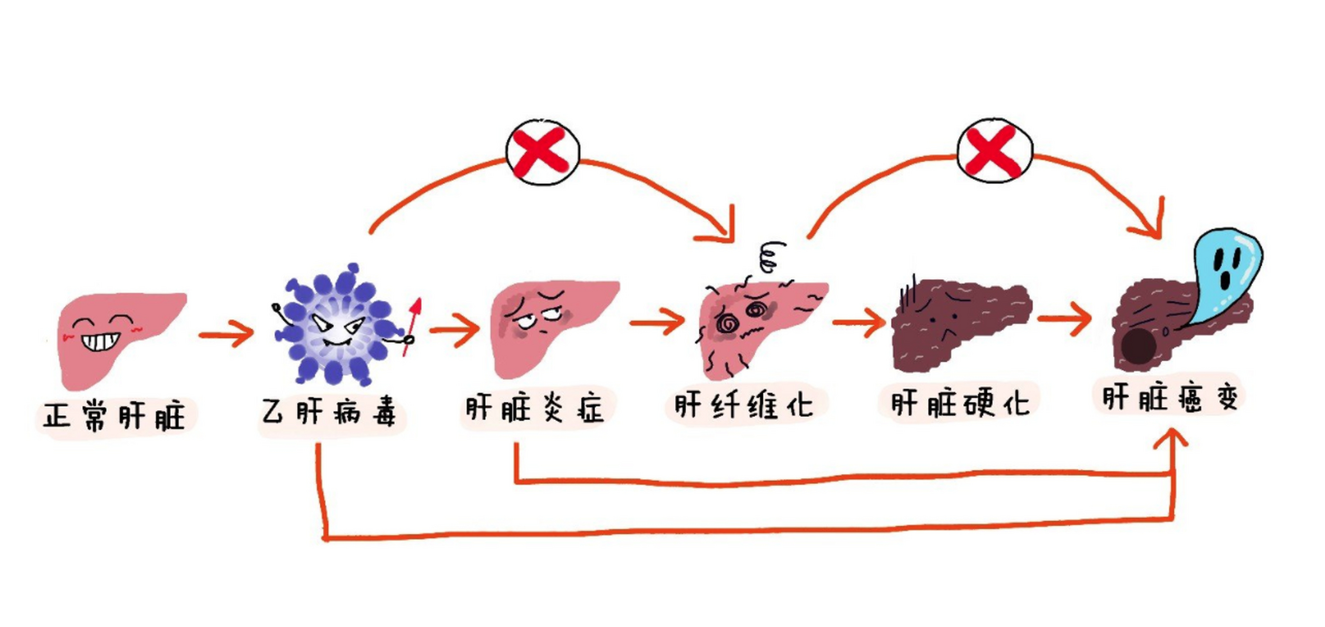 患乙型肝炎纤维化,无腹水,抗乙型肝炎病毒治疗5年.