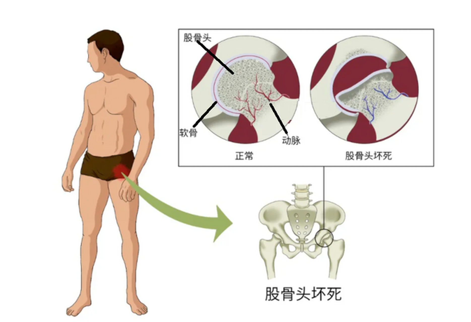 股骨头坏死早期症状图片