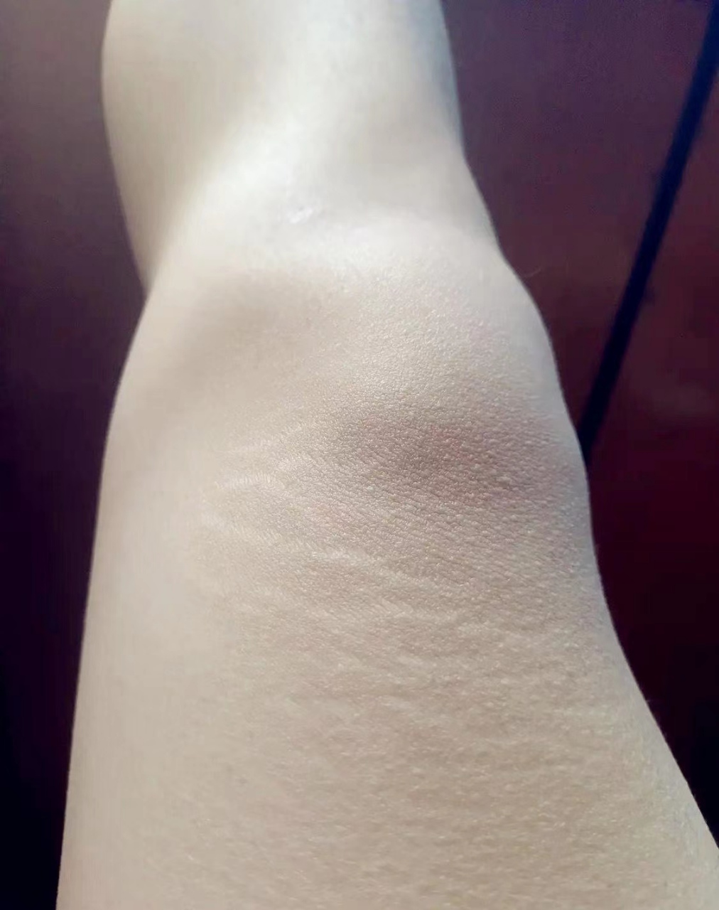 女朋友腿上有这样一条条的白纹,为什么会这样?