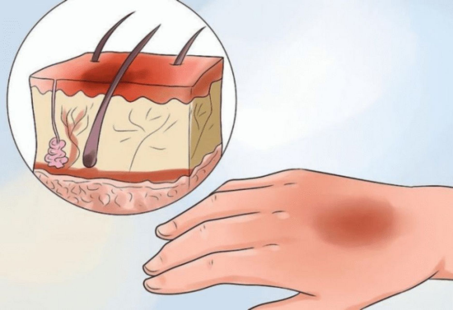 疤痕# #南京看疤痕好的医院#  如果不注意疤痕护