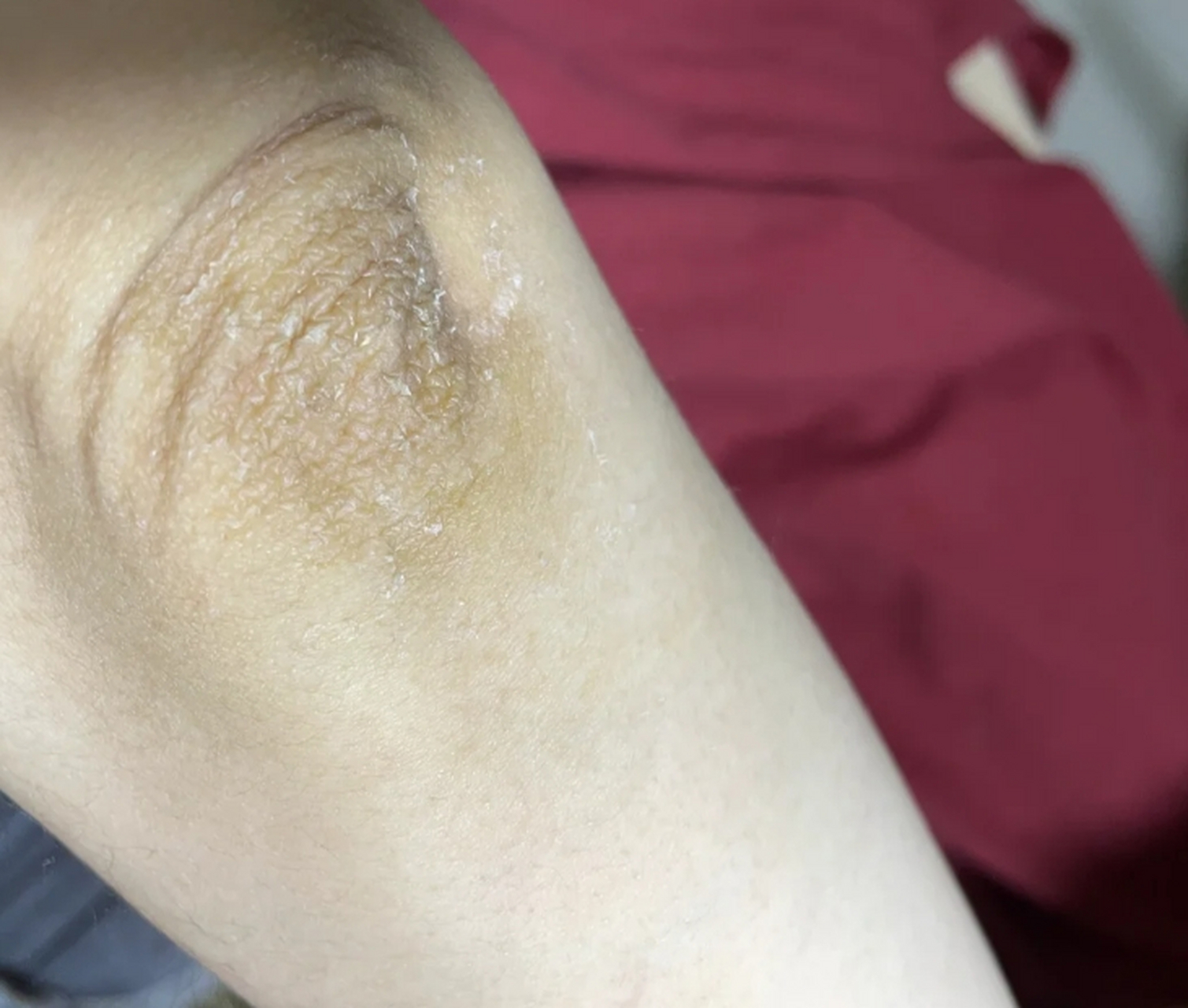 手肘黑色素沉淀怎么快速去除 #医美科普挑战赛#  手肘黑色素沉淀是