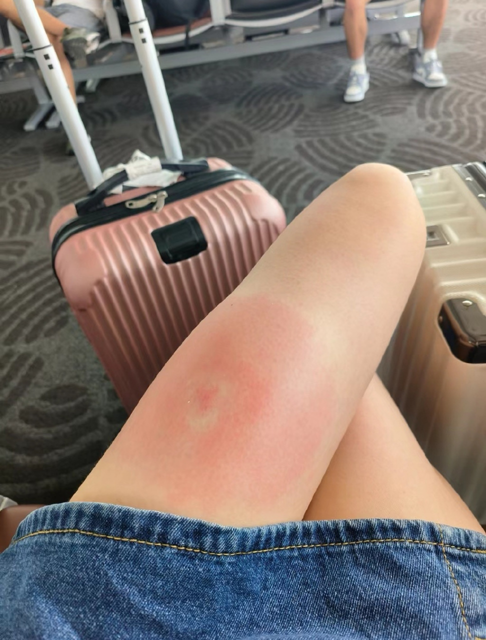 这个蚊子包是变异了吗?还是有毒?