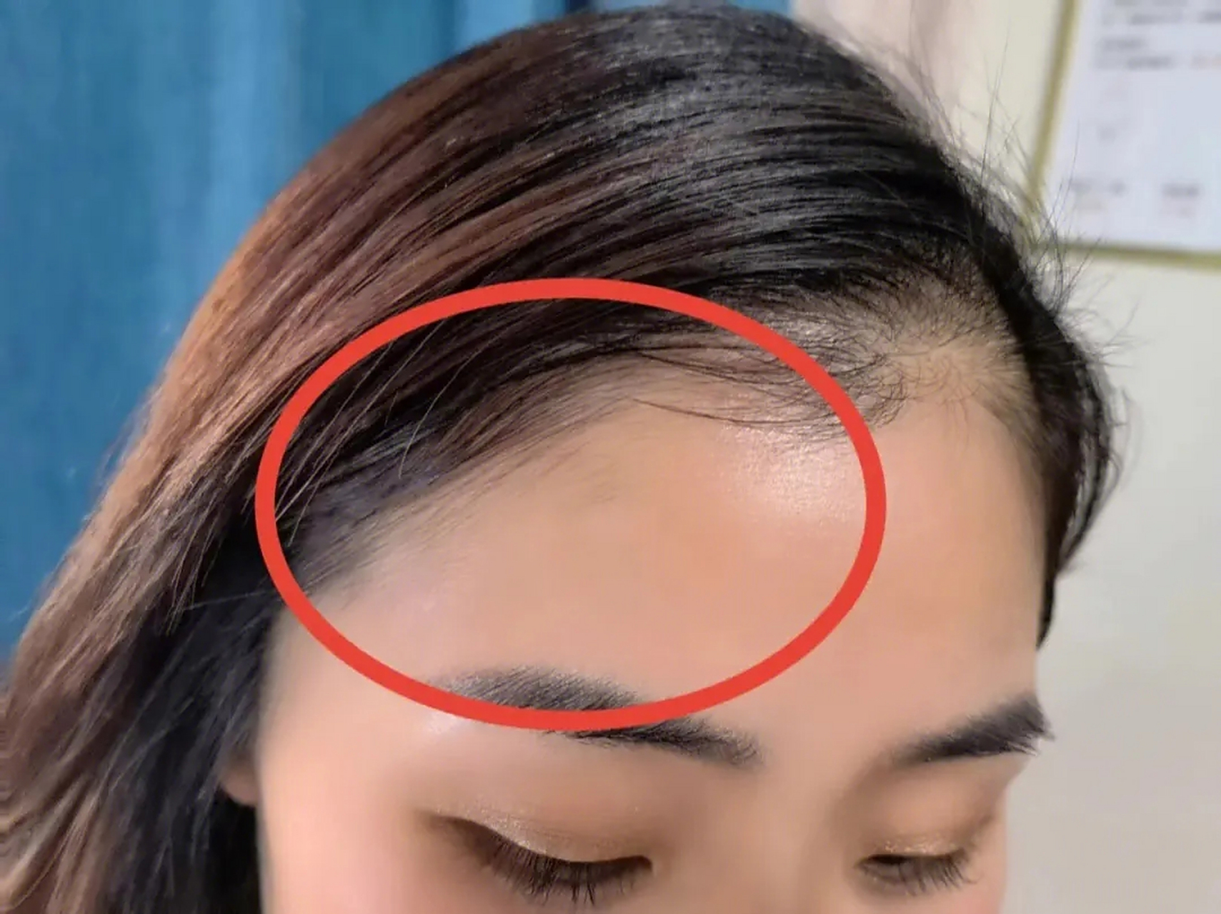 发际线越来越高,额头大面积脱发,这是怎么了?
