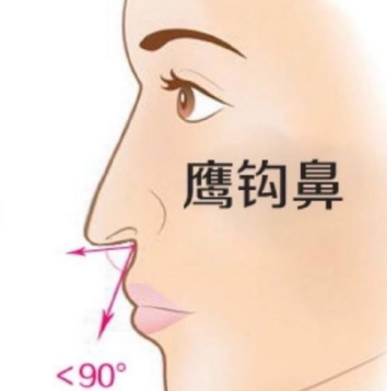 海鸥线下延太多会有鹰钩鼻的感觉: 改善方式:在矫正手术时,需要调整