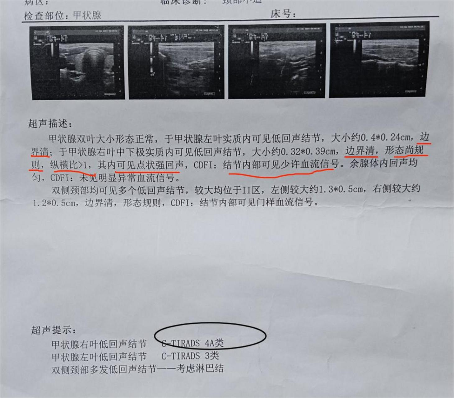 甲状腺彩超报告单分级偏高,如何判断是不是良性结节?