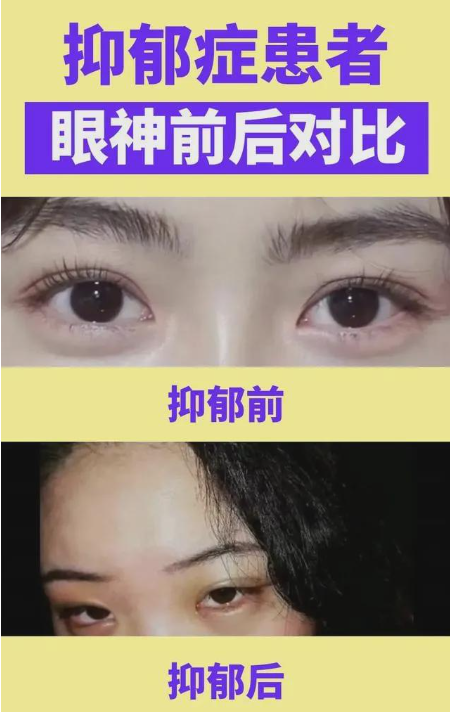 眼睛 眼神会变得飘忽不定,空洞无神,逃避 一项哈佛的研究显示,抑郁症