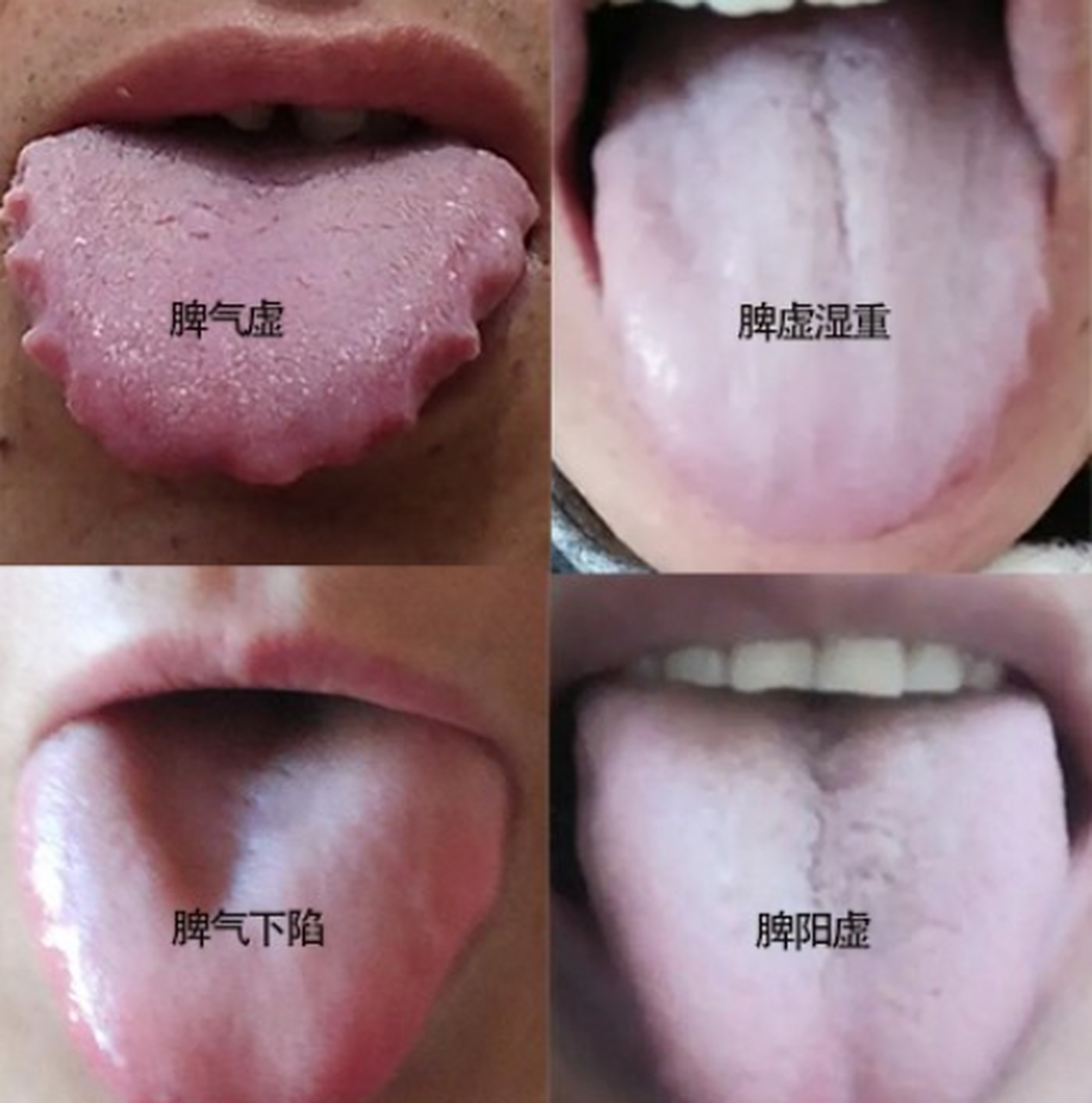 脾虚常见四种症状,以及对应的舌象分享,后面带解决方法   1:脾气虚