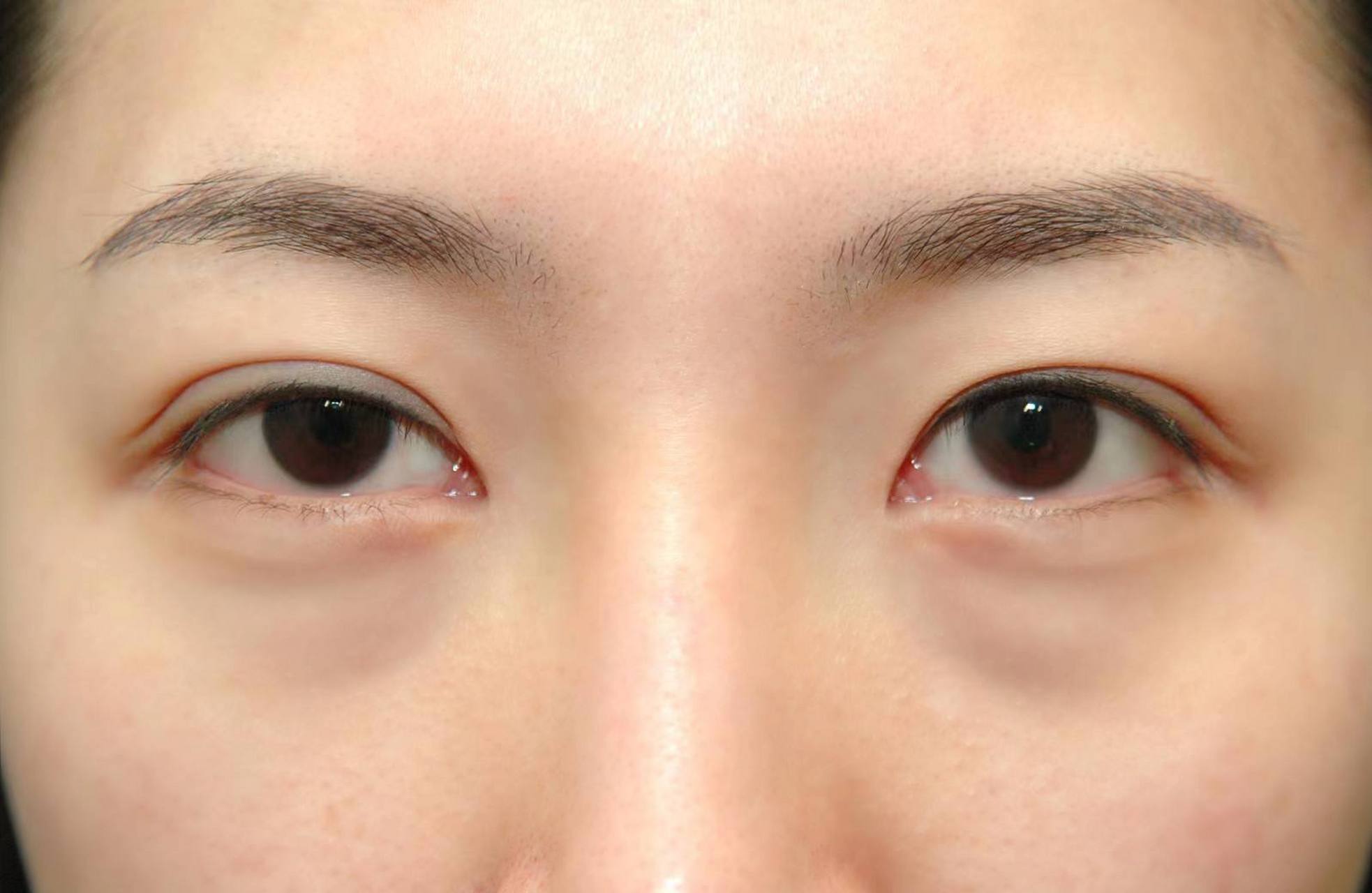 眼袋越早切越好?