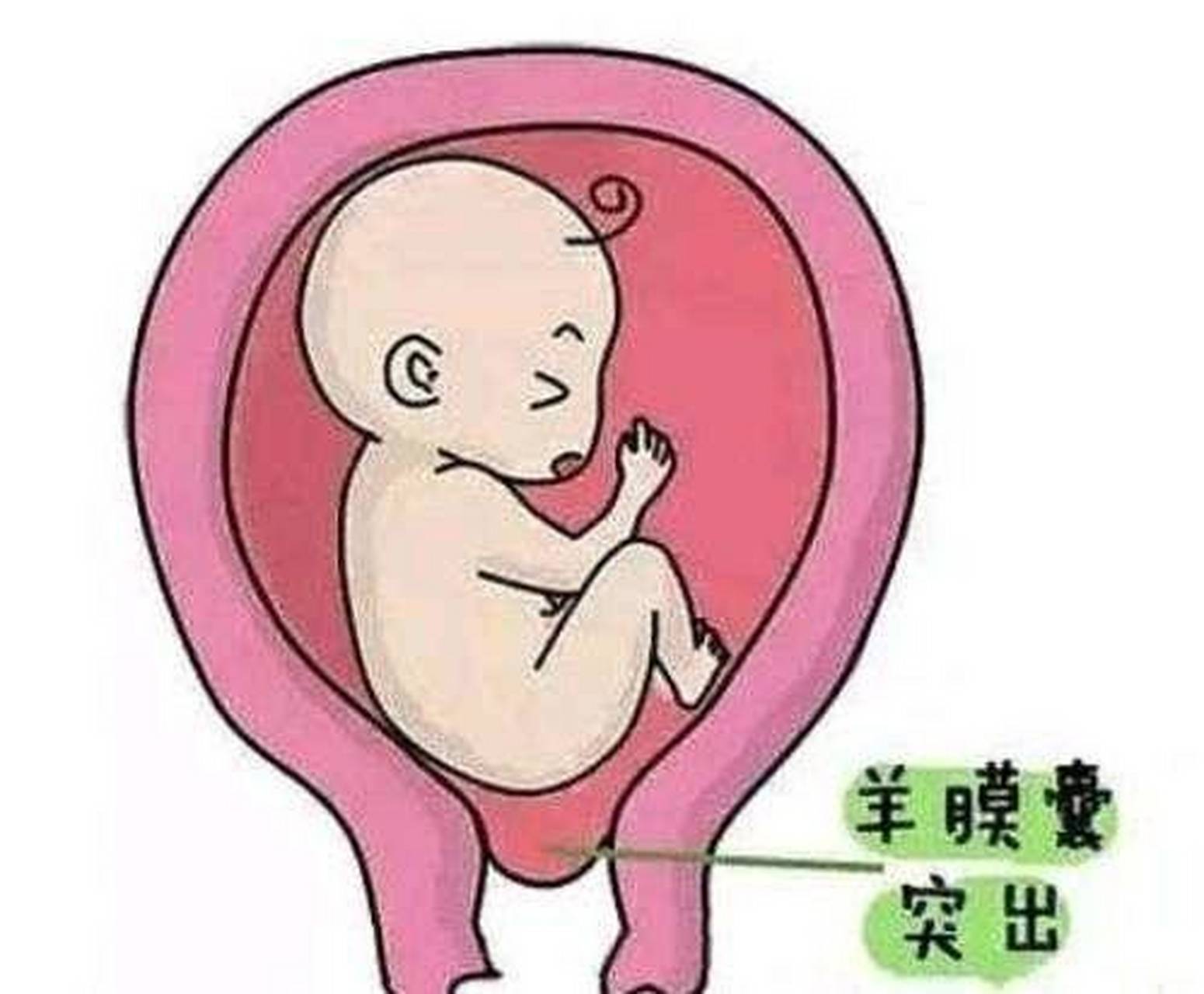 反复liu 产怎么办,可能是宫颈机能不全导致 反复liu