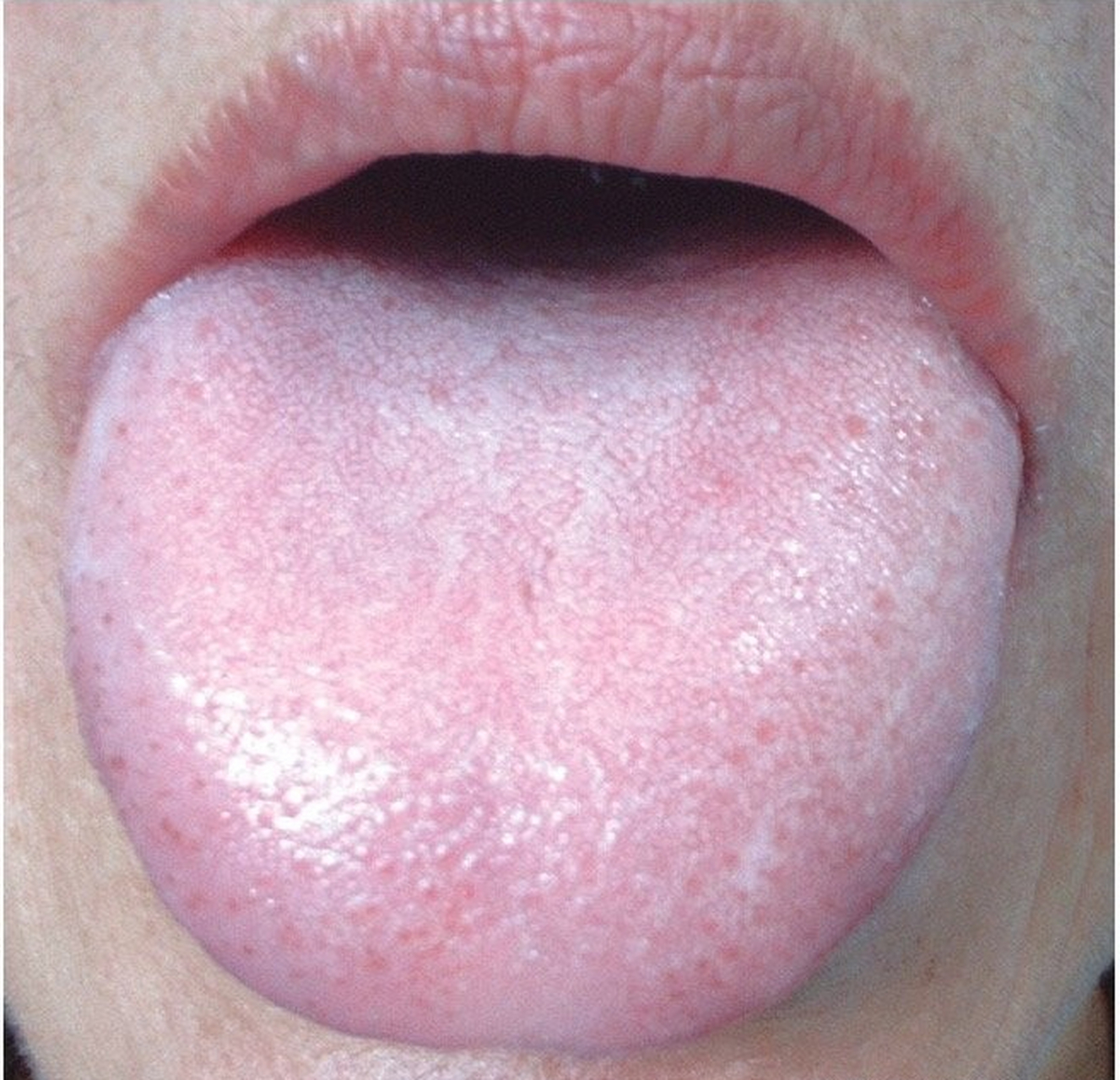 舌头背面正常颜色图片