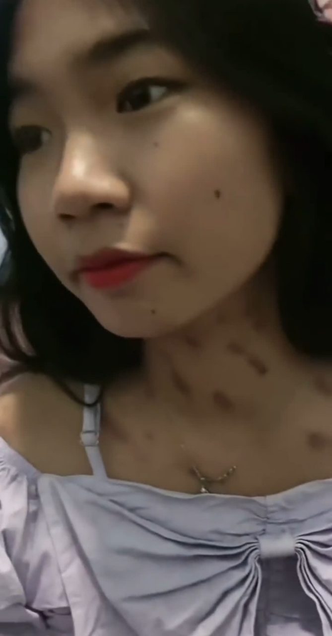 出差一周回来,女朋友说被臭虫咬了[哭][没眼看]