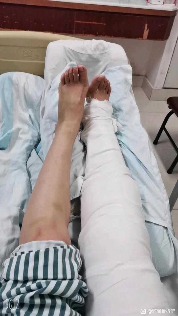 也就是这几天因膝盖疼痛网上各种收索找到了这个髌骨骨折吧,那就讲讲